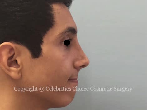 After-nose21