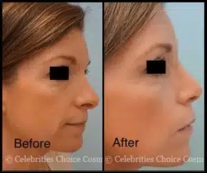 revision rhinoplasty