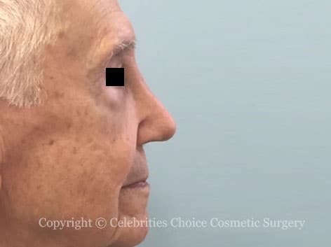 Before-1nose31