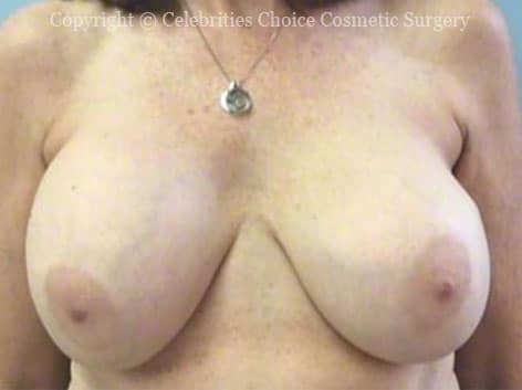 Before-RevisionalBreastSurgery7 b
