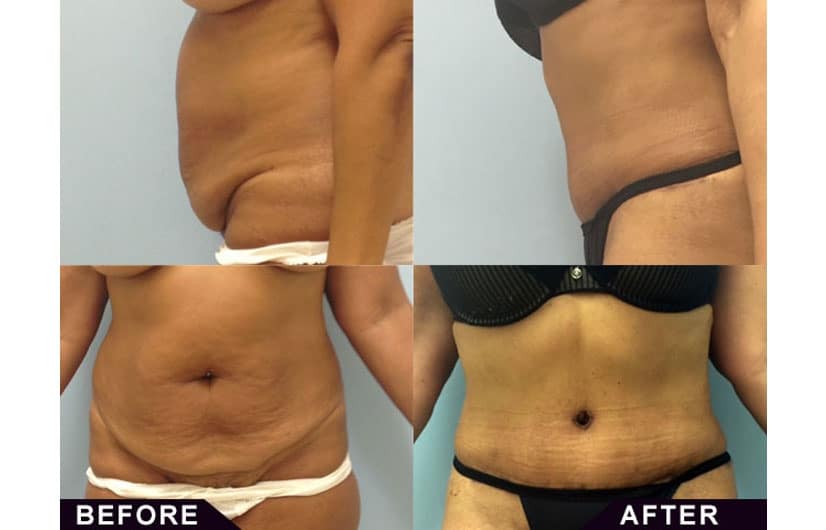 Perfect for Abdominoplasty or “tummy tuck”. Abdominoplasty or