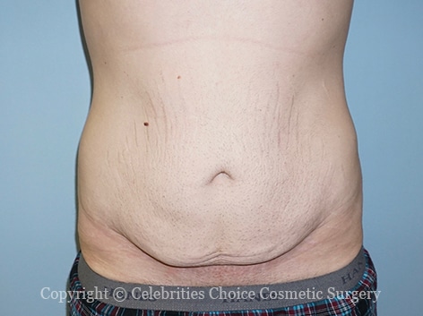 Before-tummy 1