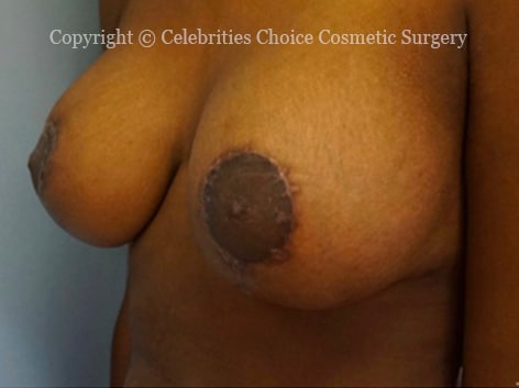 After-BreastLiftwithImplants1234