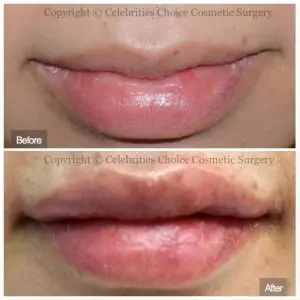 lip augmentation