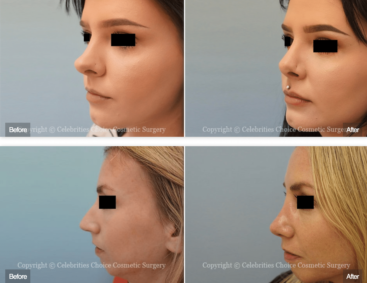 good noses for nose job