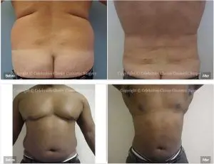 liposculpting