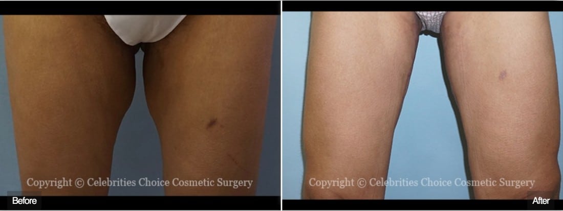 Thigh Liposuction. Your Best Option For Great Legs - Moawad Skin Institute  (MSI)