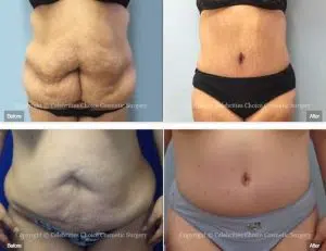 tummy tuck