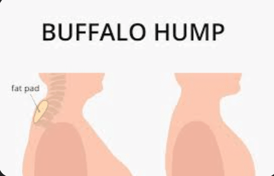 buffalo hump