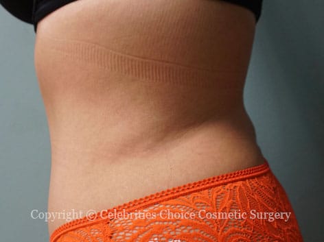 Tummy Tuck Scars - Celebrities Choice Cosmetic Surgery - Dr. Trevisani