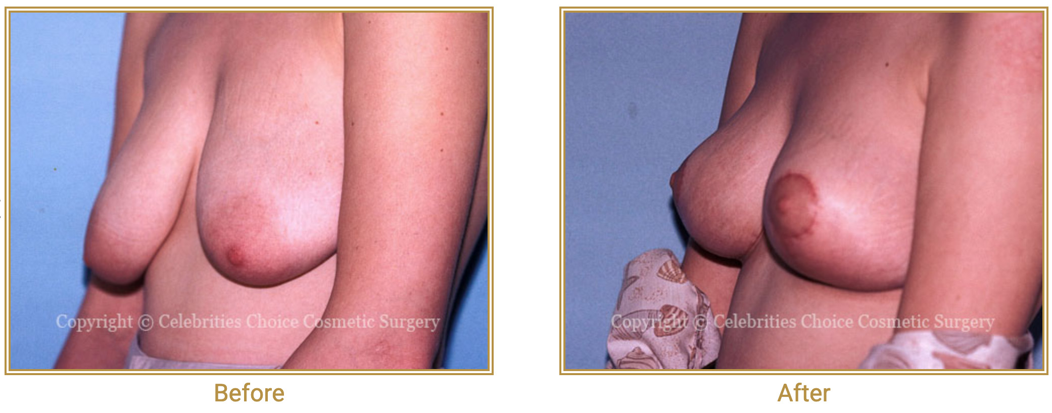 Will Implants Correct Saggy Breasts before and after