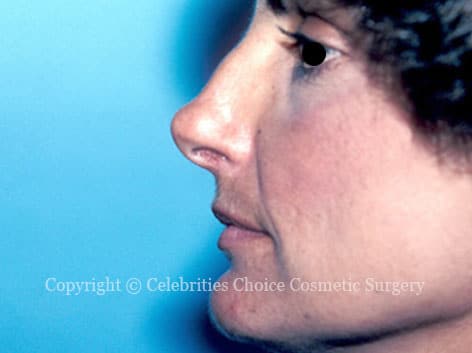 Before-Nose Job 1