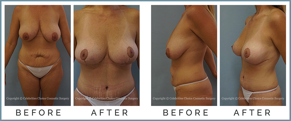 Extended Breast Lift, Extended Tummy Tuck with Muscle Tightening- post several pregnancies, 1 month po