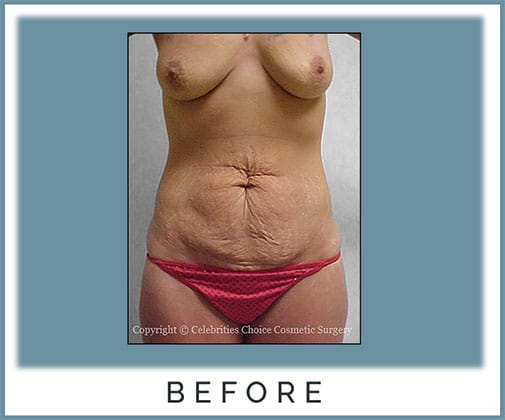 Breast Lift, Tummy Tuck with Muscle Tightening -post several pregnancies, 3 months post op