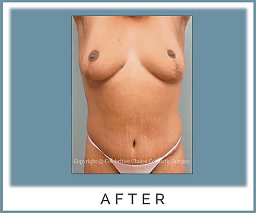 Breast Reduction/ Lift, Extended Tummy Tuck with Hip Liposuction
