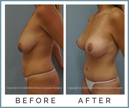 Extended Breast Lift, Extended Tummy Tuck with Muscle Tightening - post several pregnancies, 1 month po