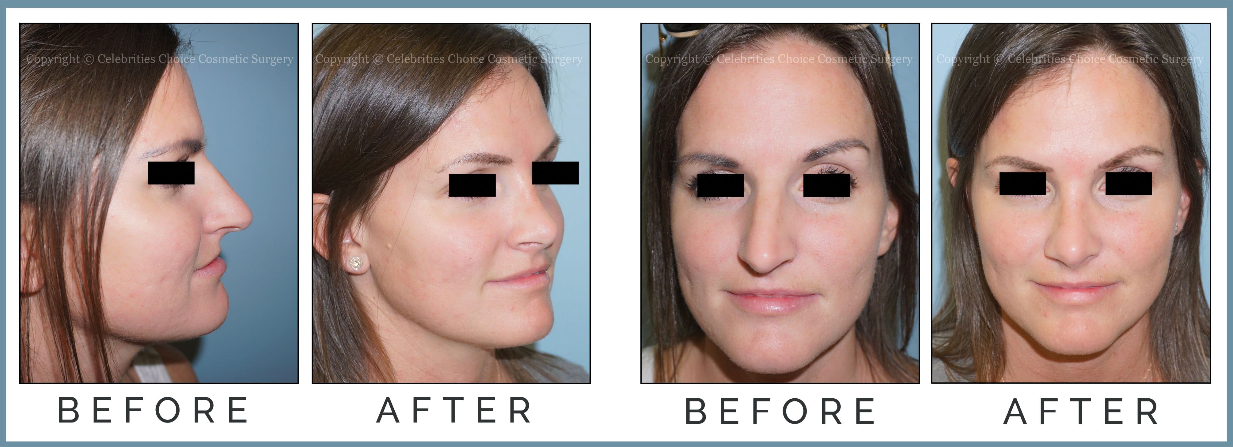 Reduction Rhinoplasty performed through a Closed Technique