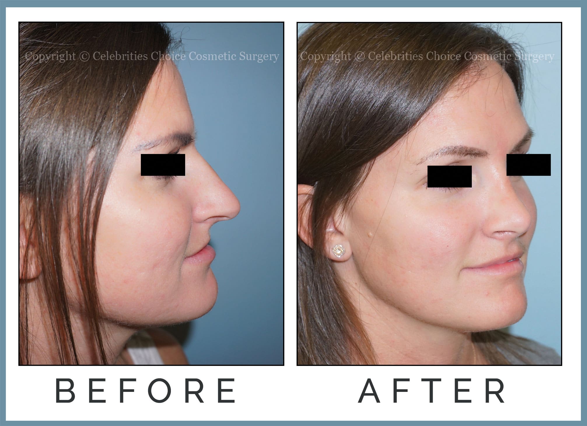 Reduction Rhinoplasty performed through a Closed Technique
