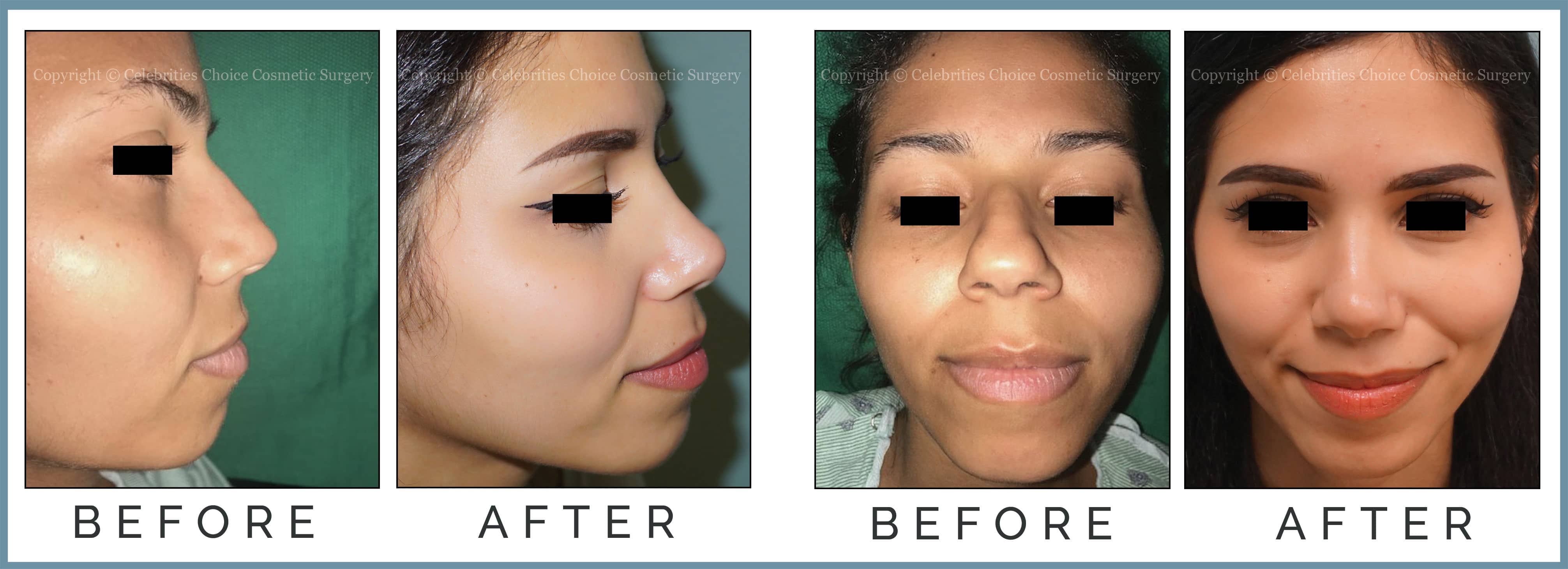 Reduction Rhinoplasty performed through a closed technique