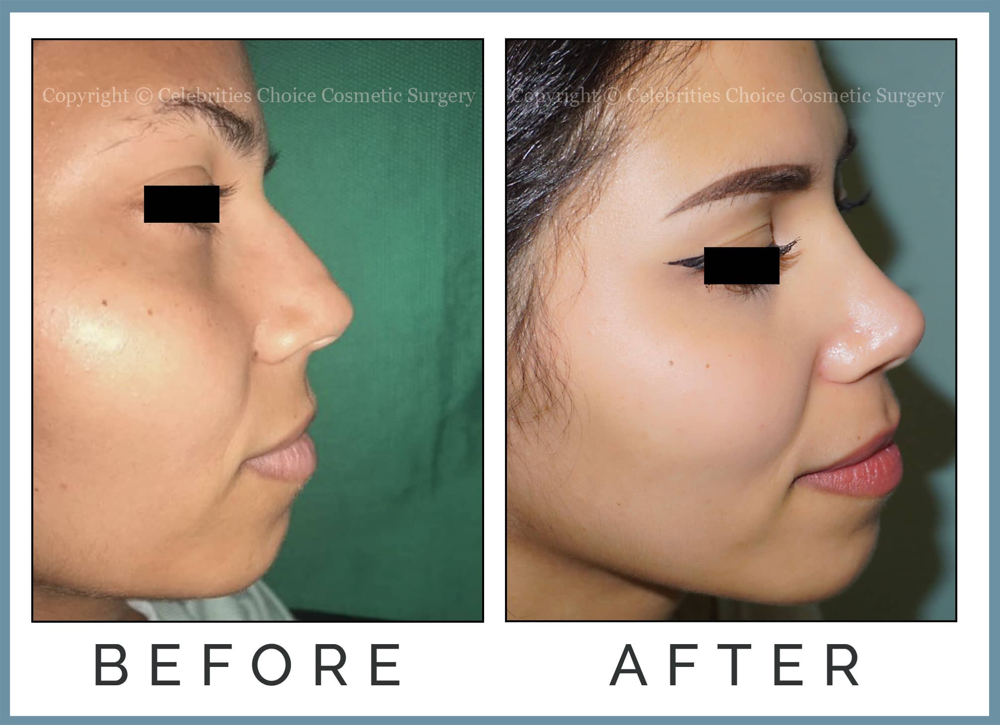Reduction Rhinoplasty performed through a closed technique 