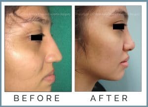 Rhinoplasty Nose Surgery - Trevisani Best Plastic Surgeon Orlando