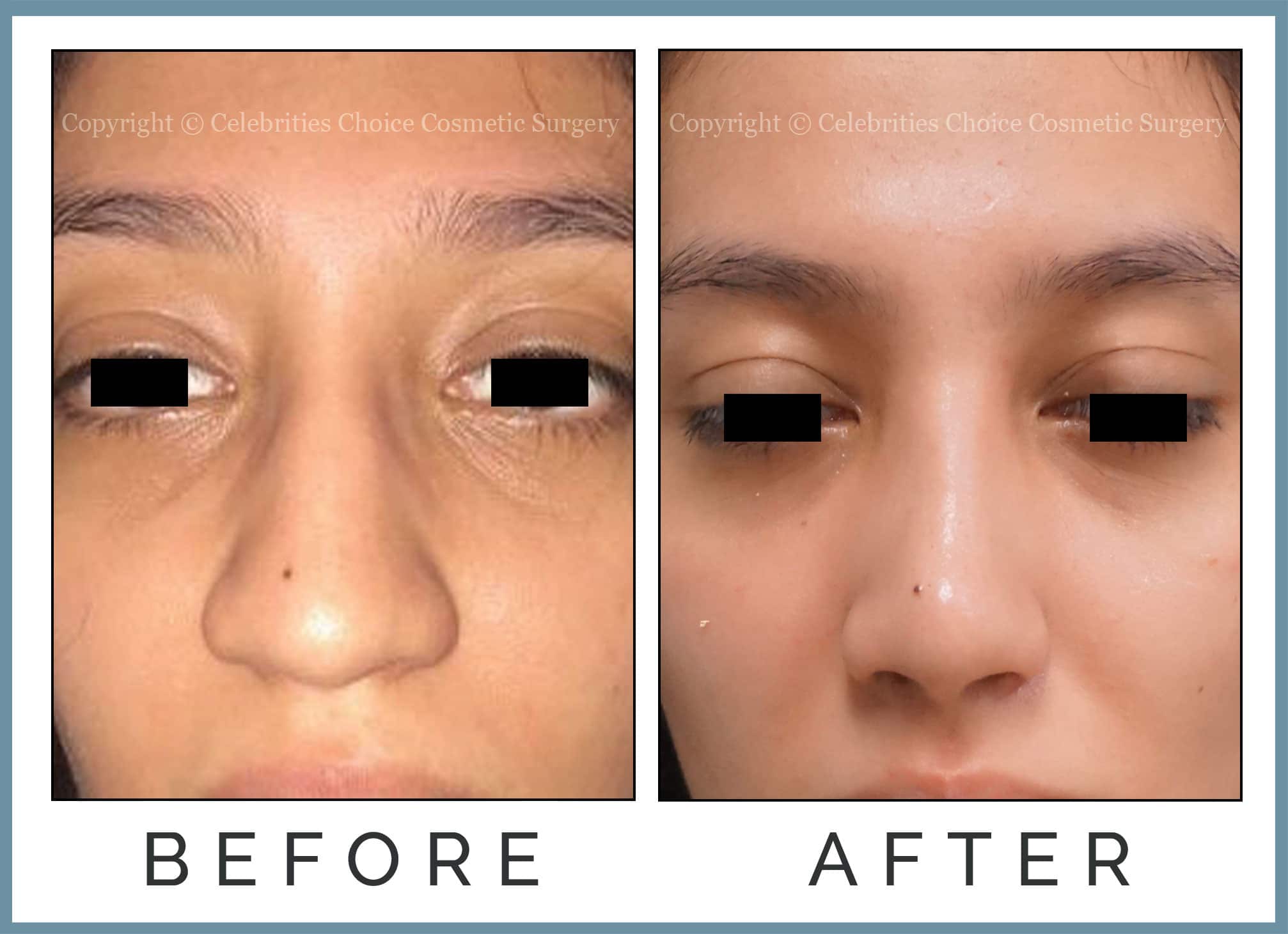 Reduction/ Augmentation Rhinoplasty through a closed technique with Cartilage Grafting with Nostril Contouring