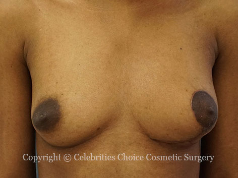 After-BreastReconstruction