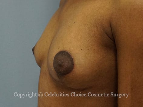 After-BreastReconstruction