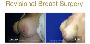 breast revision orlando