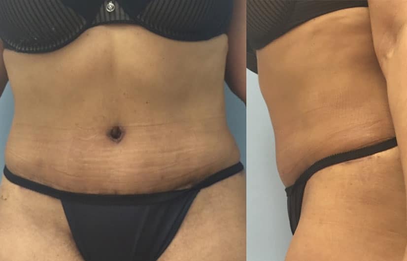 Tummy Tuck Scars - Celebrities Choice Cosmetic Surgery - Dr. Trevisani
